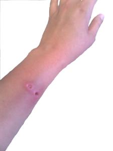 arm piercing Exhibit A: the aftermath of the arm piercing